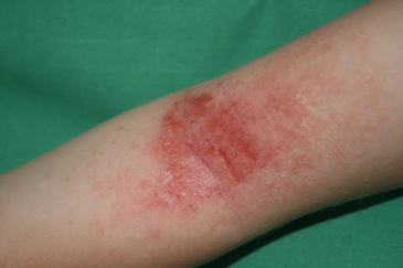 eczema atopique