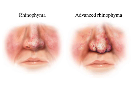 rhinophyma